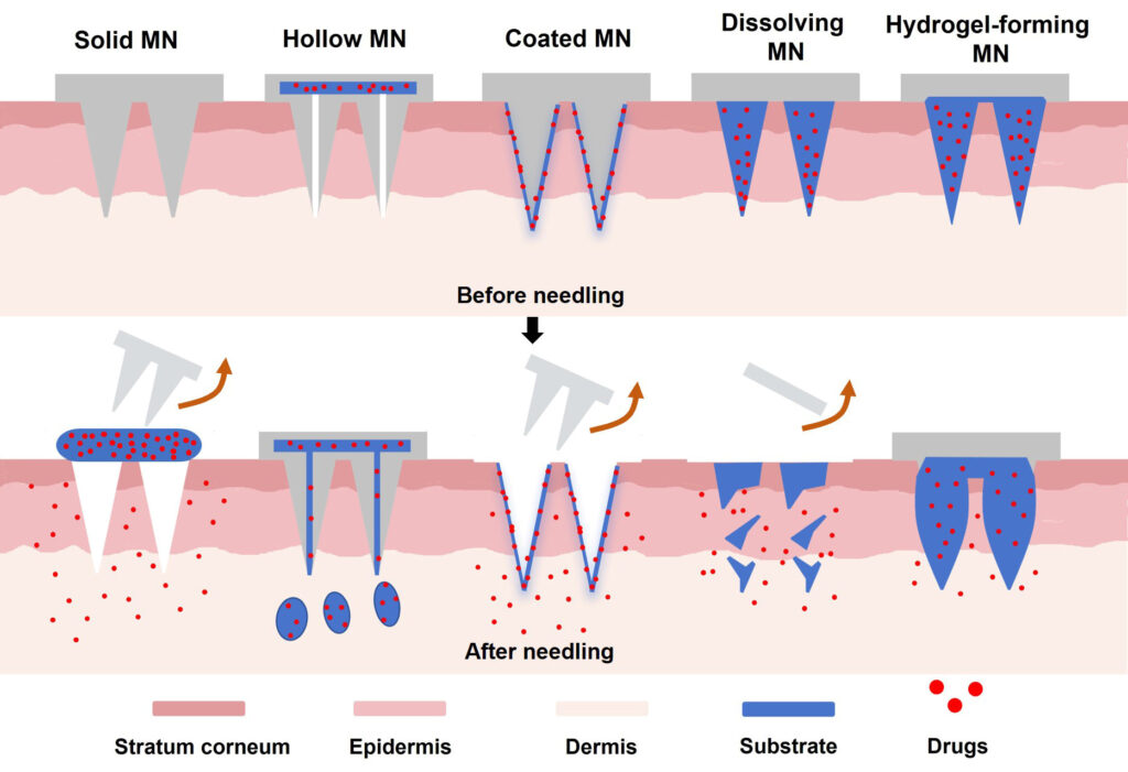 The New Era of Polysaccharide Microneedle Drug Delivery — Ebclink Leads the Industrialization of Minimally Invasive Corneal Therapy Technology