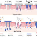 The New Era of Polysaccharide Microneedle Drug Delivery — Ebclink Leads the Industrialization of Minimally Invasive Corneal Therapy Technology